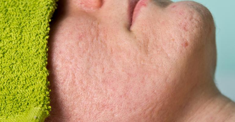 10 Treatments for acne scarring